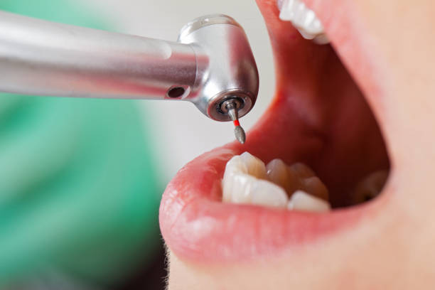 Best Emergency Broken Tooth Repair in Linthicum, MD